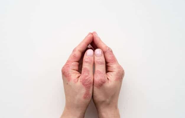 Ayurvedic Treatment for Psoriasis