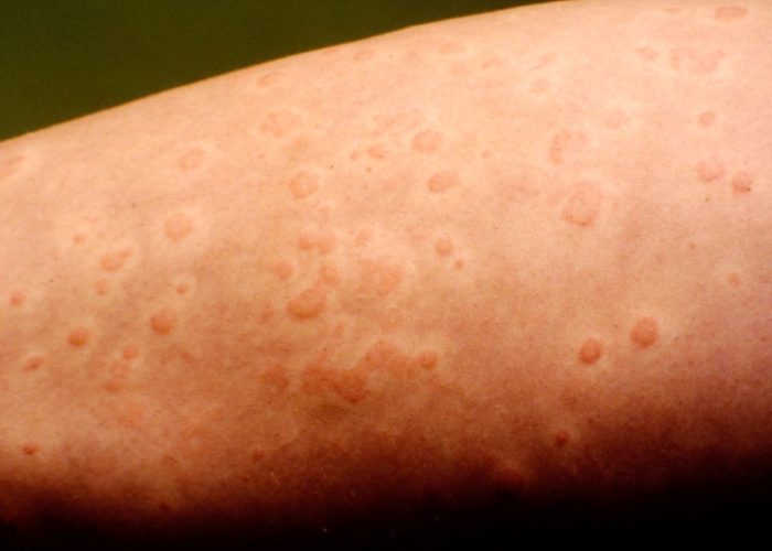 Ayurvedic Treatment for Urticaria